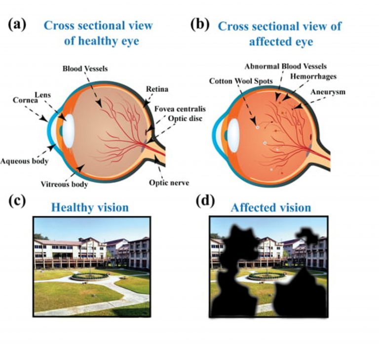 IIT Guwahati researchers 2020: Great work for easy diabetic retinopathy detection